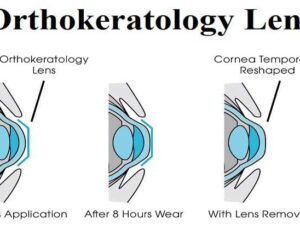 Terapi Orthokeratology