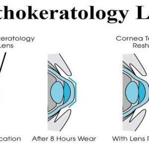 Terapi Orthokeratology