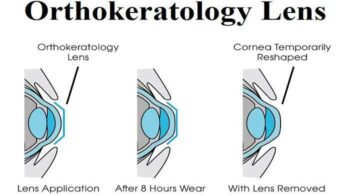 Terapi Orthokeratology