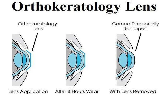 Terapi Orthokeratology