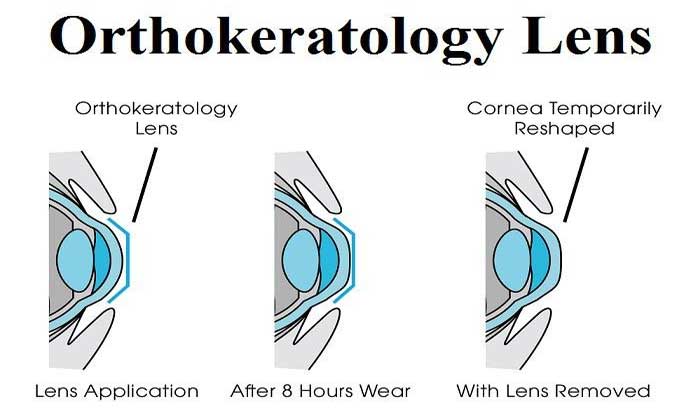 Terapi Orthokeratology